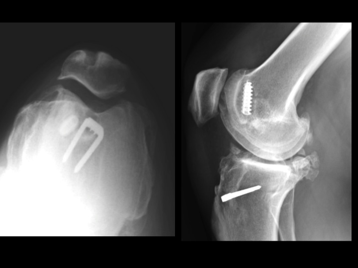 Figure 2 for case ACL graft device ( RID5523 )
